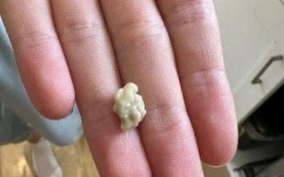 Here’s what you need to know about tonsil stones – the weird pimple-like growths in your throat