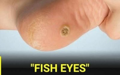 Plantar warts on the feet: what they are and why they shouldn’t be mistaken for a regular callus