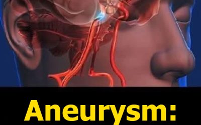 Aneurysm: Signs You Shouldn’t Ignore and What You Need to Know