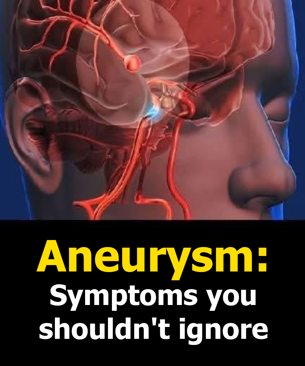 Aneurysm: Signs You Shouldn’t Ignore and What You Need to Know