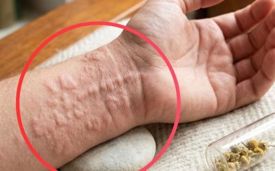 8 Surprising Hives Triggers You Might Be Overlooking
