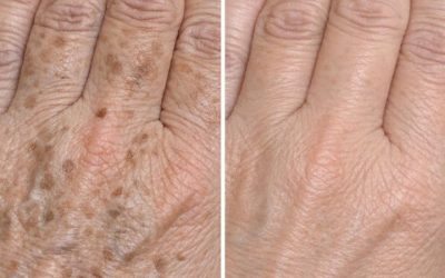 My mom taught me this trick to diminish dark age spots on my hands in just 3 mins with 0 effort. Here’s how it works