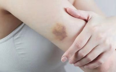 BE CAREFUL, if you get these bruises on your body, it means you have Ca…see more
