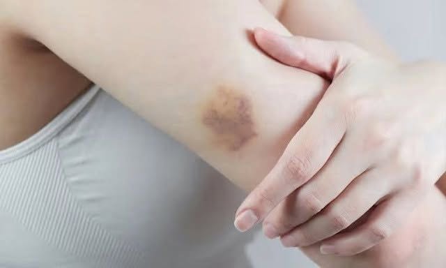 BE CAREFUL, if you get these bruises on your body, it means you have Ca…see more