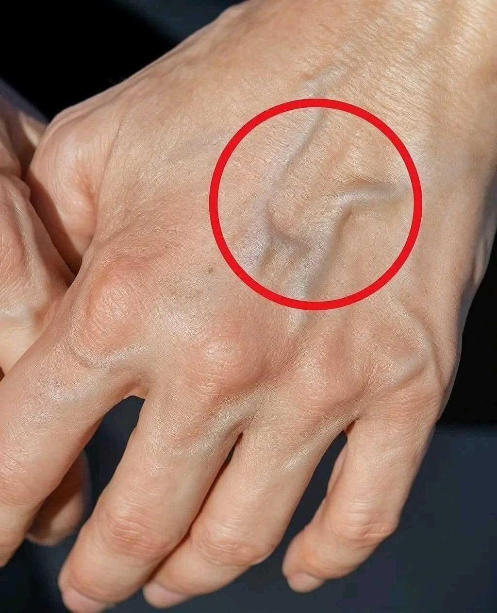Visible Veins: The Real Reasons and Consequences for Your Health