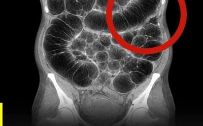 Frequent intestinal gas: the real causes that almost no one clearly explains
