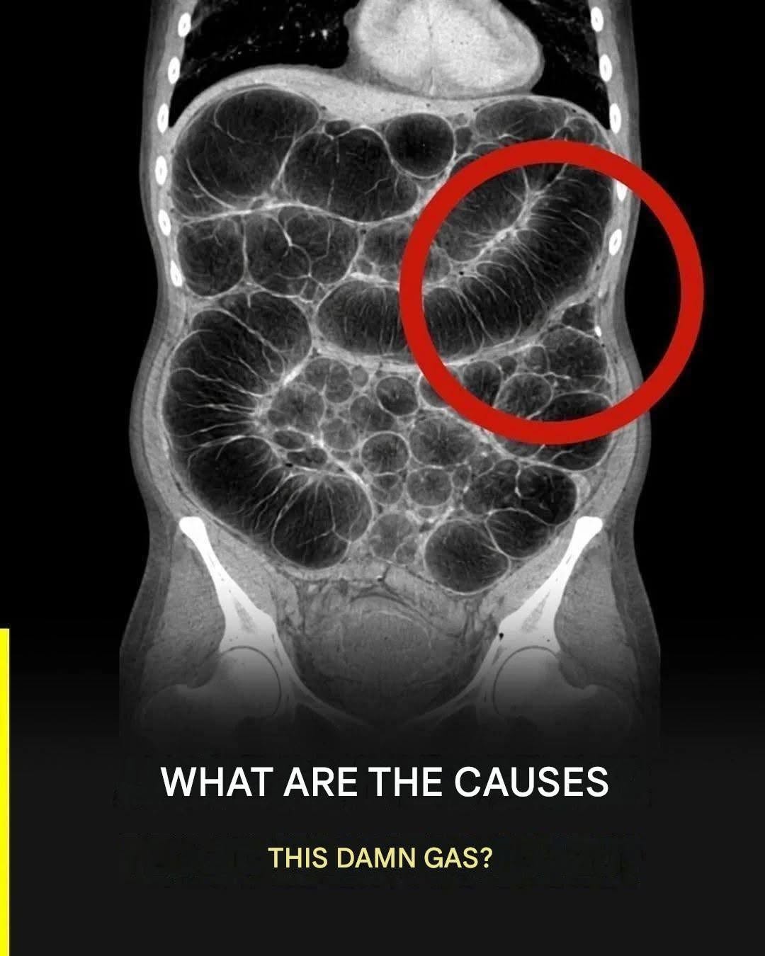 Frequent intestinal gas: the real causes that almost no one clearly explains