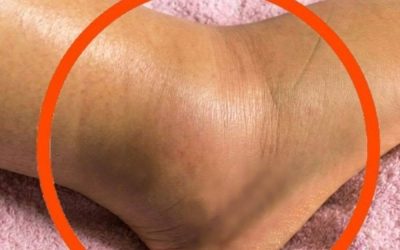 If You Notice Your Legs Are Swollen, Doctors Warn It Could Be a Sign of