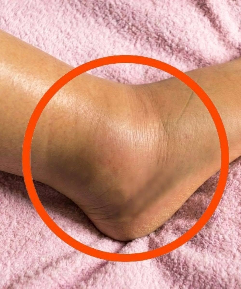 If You Notice Your Legs Are Swollen, Doctors Warn It Could Be a Sign of