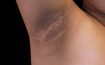 Search Results for: These are the first symptoms of cr…See more –