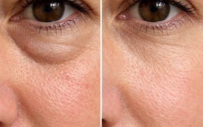 Place this 1 trick under your eyes and get rid of puffiness, swelling, and tired sagging skin 1