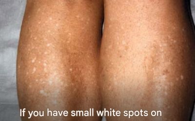 Why do I get white spots on my skin in the summer and how can I treat them? A dermatologist answers.