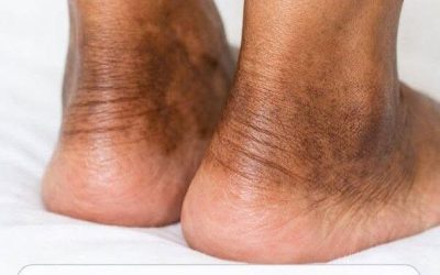 The skin around my ankles is getting darker and thicker over time. What causes this?