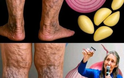 Natural and Effective Way to Say Goodbye to Varicose Veins