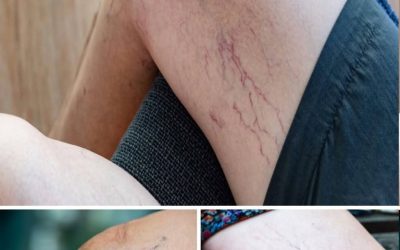 What Do Purple Veins on Your Legs Mean? Understanding the Common Causes
