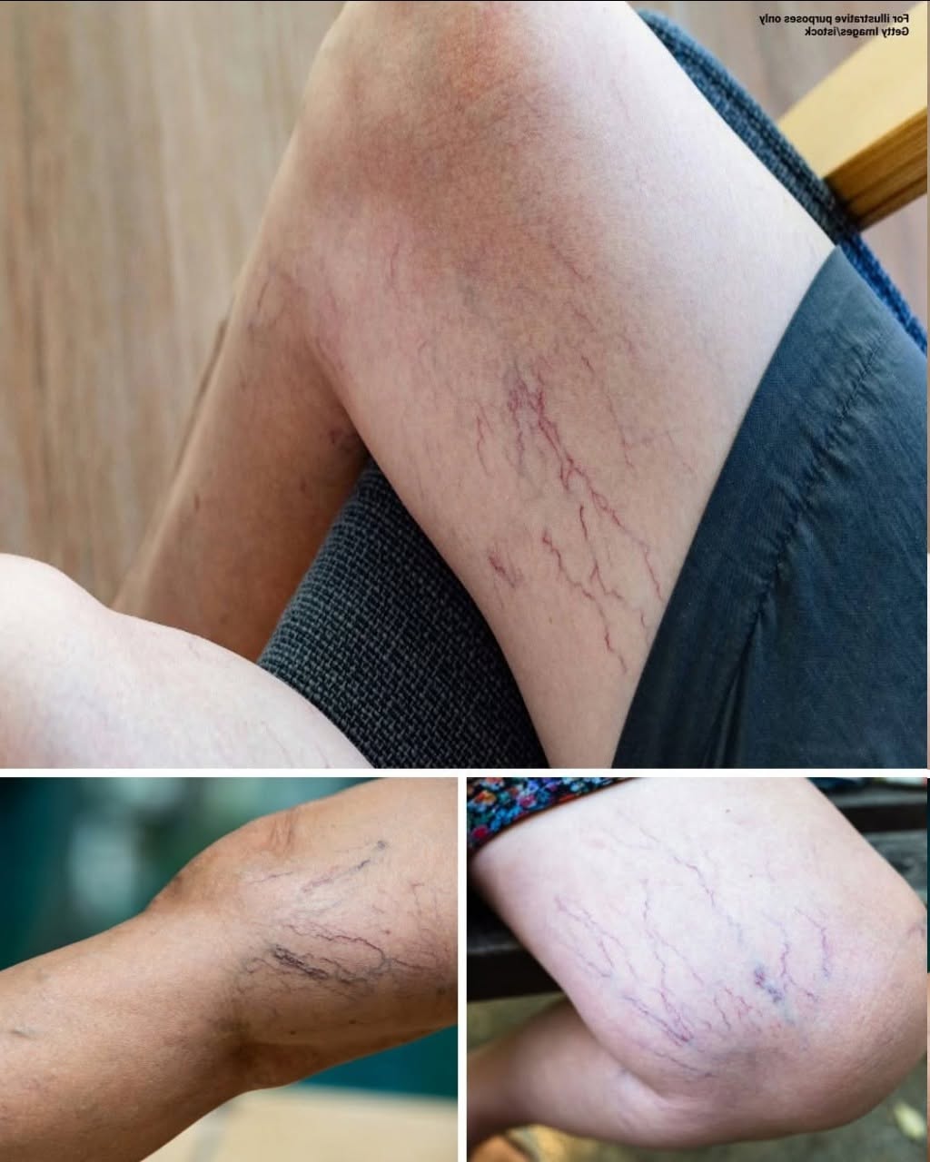 What Do Purple Veins on Your Legs Mean? Understanding the Common Causes