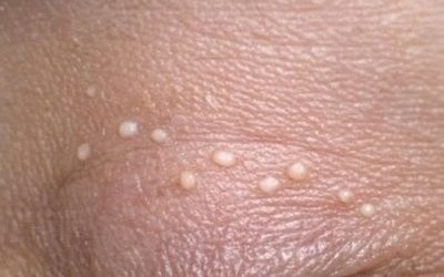 Tiny white bumps keep showing up on my eyelids, and I can’t get in to be seen yet. What are these?