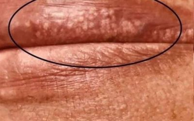 If you are getting these pimples on your lips or int;im:ate area, it is because… See more