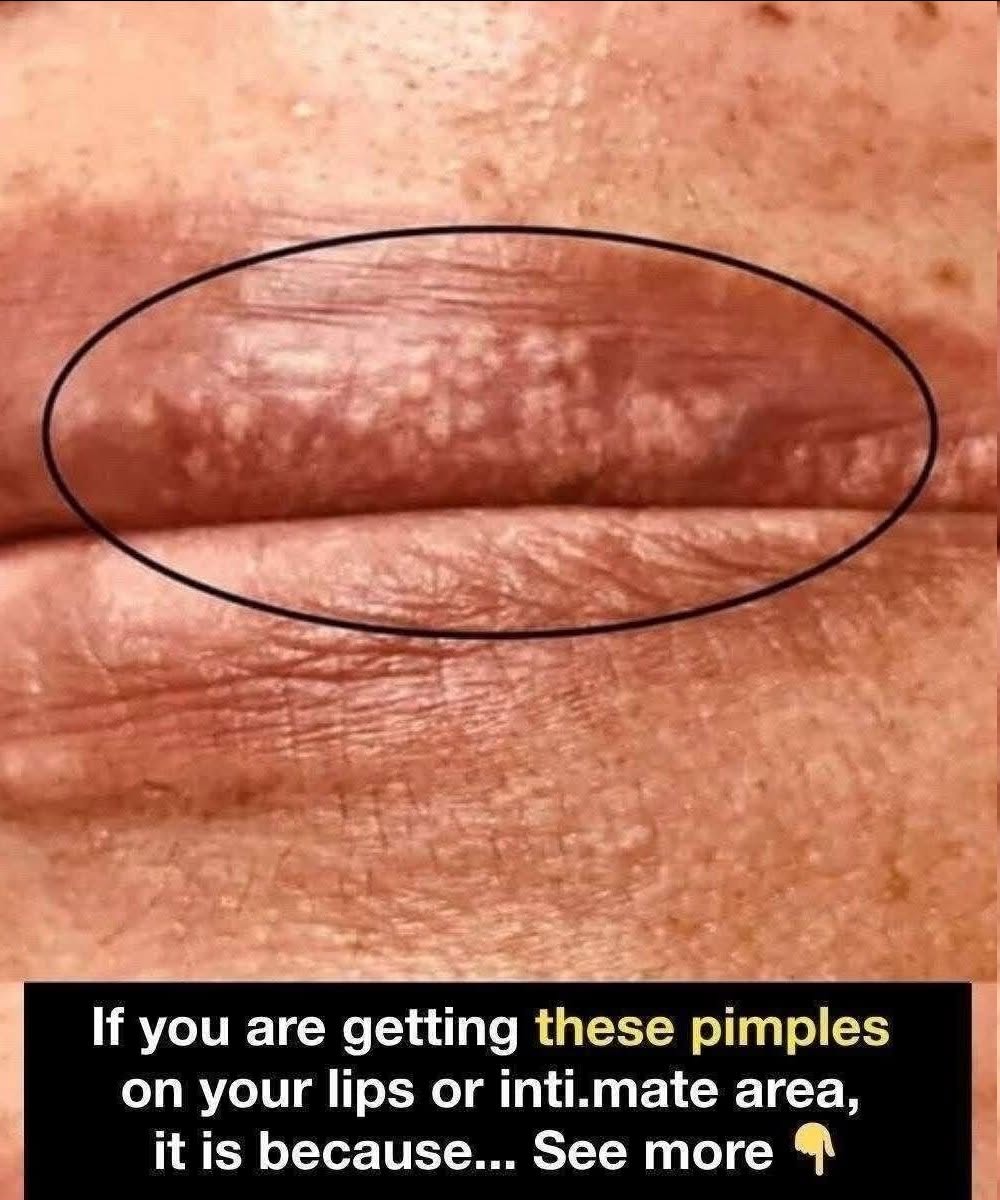 If you are getting these pimples on your lips or int;im:ate area, it is because… See more