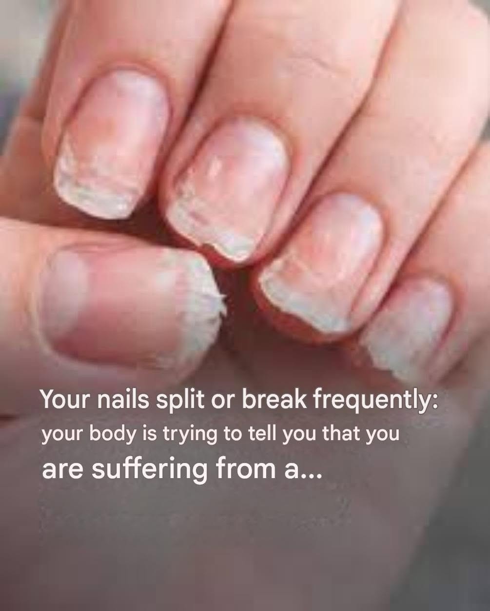 Your nails are breaking or splitting: this detail reveals a problem