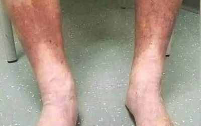 Swollen Feet and Ankles: 10 Possible Causes, Warning Signs, and When to See a Doctor