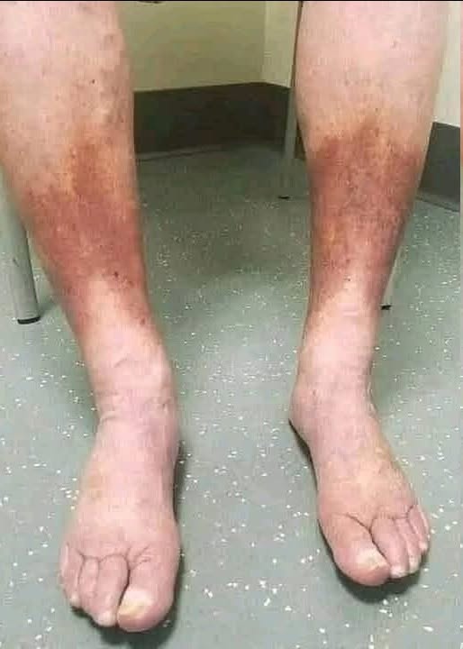 Swollen Feet and Ankles: 10 Possible Causes, Warning Signs, and When to See a Doctor