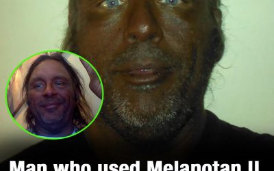 Man who used Melanotan II injections for 20 years shares his warning