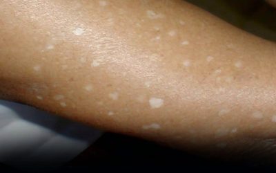 What Vitamin Deficiencies May Lead to White Spots on the Skin