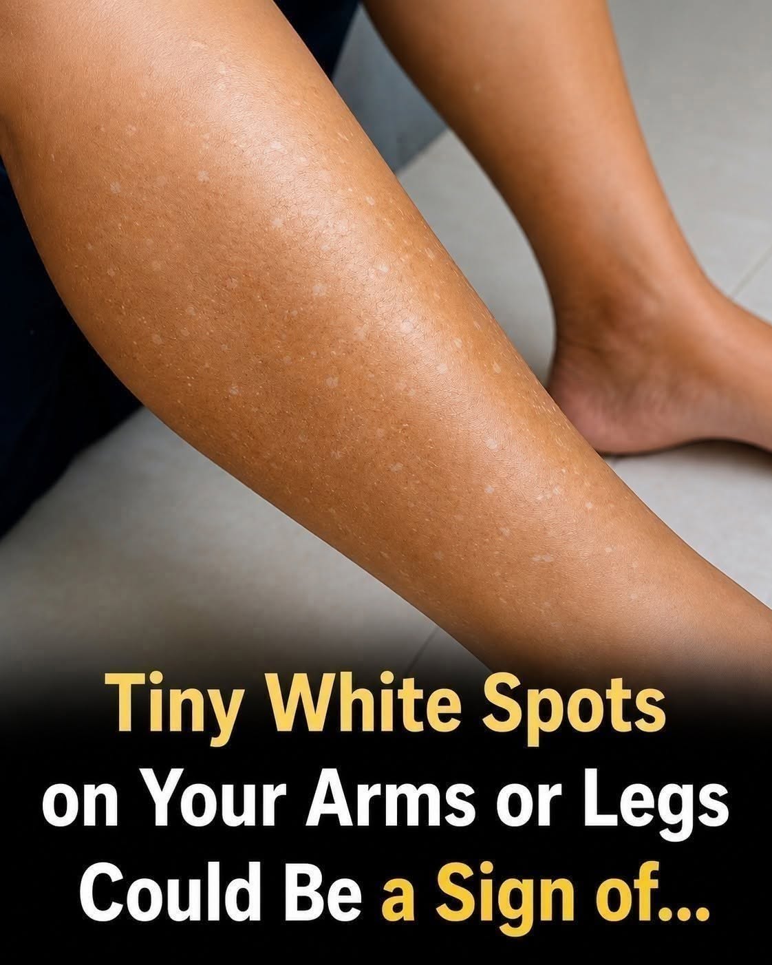 Tiny White Spots on Your Arms or Legs? Here’s What They Could Be Telling You