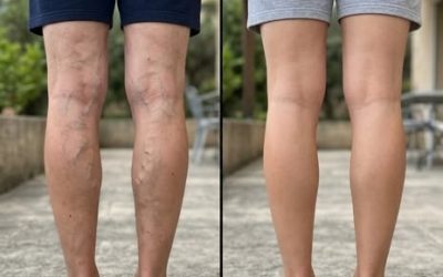Leg pain, rheumatism, varicose veins, arthritis. My mother could no longer walk because of the pain.