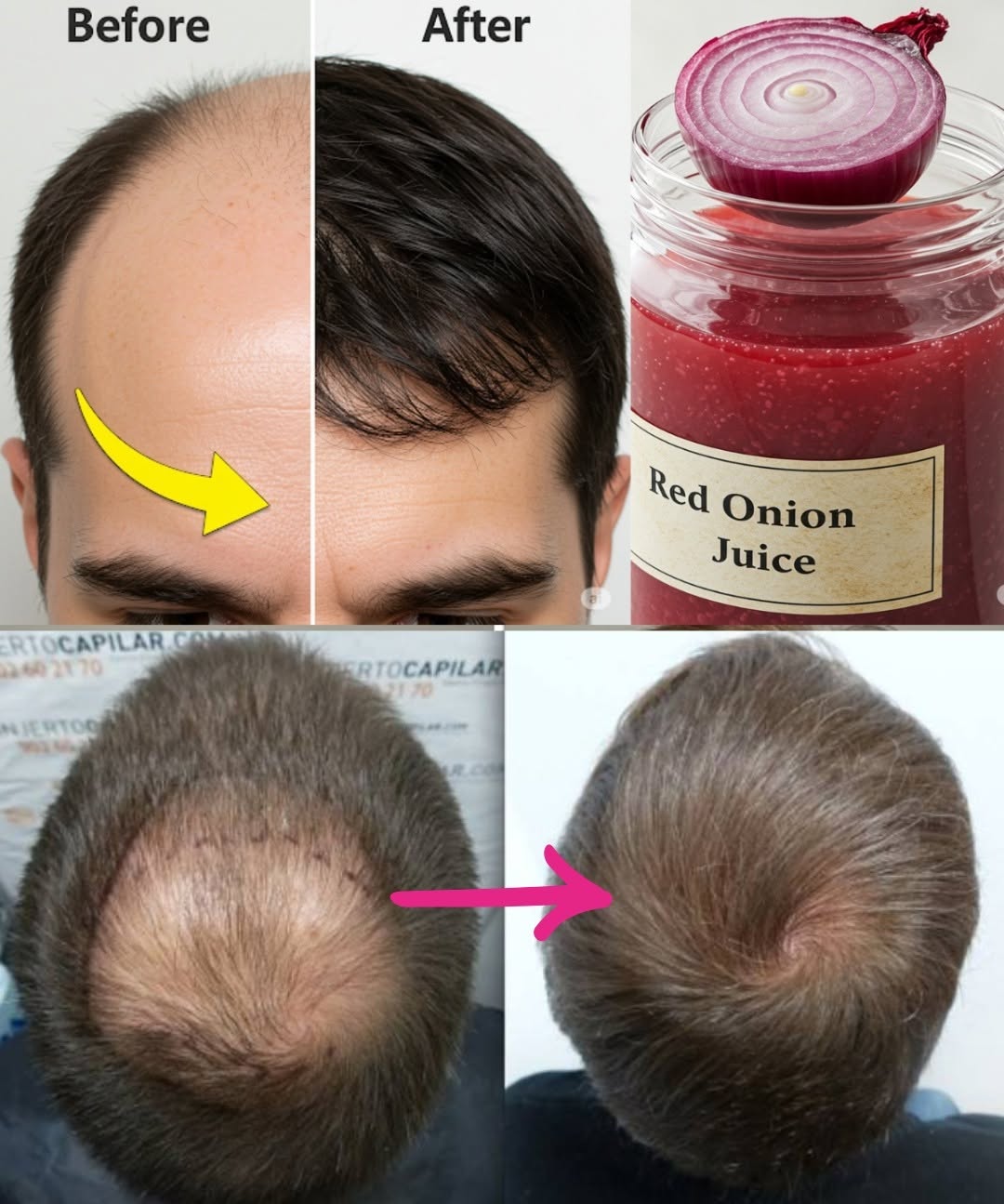 I’m shocked! With the help of this ingredient, the hair on my bald spot is growing like crazy! Must express something to keep getting my recipes…. Thank you Recipe in (c.o.m.m.e.n.t ).…