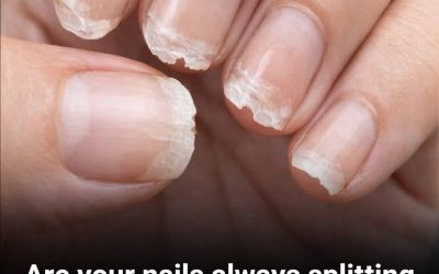 Weak or Brittle Nails: What Your Body Is Trying to Tell You